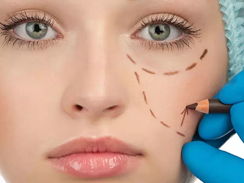 بلفاروپلاستی چشم